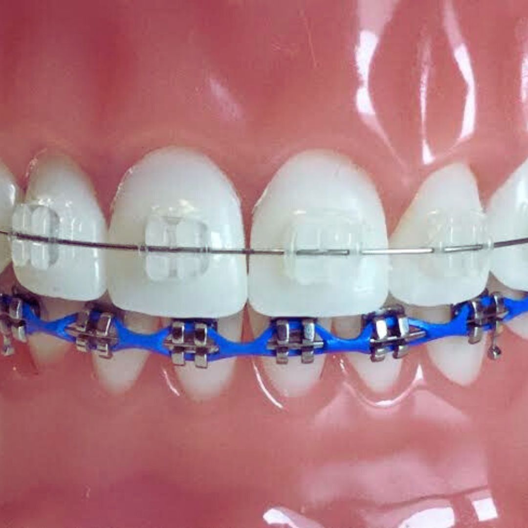 Ultimate Guide to Ceramic Braces for Teeth Gaps: Cost, Benefits, and Treatment Process