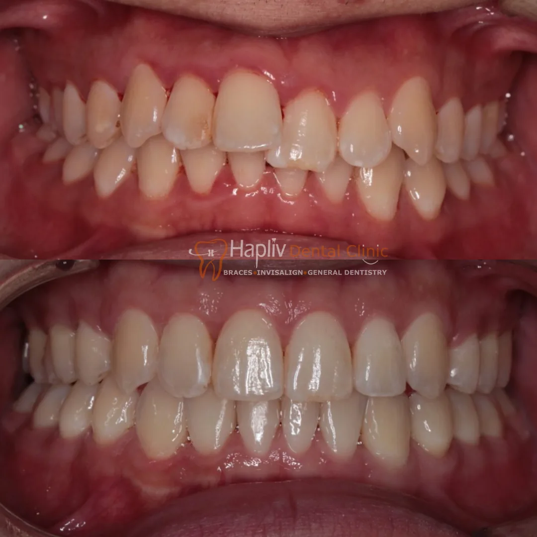 Invisalign Deep Bite case