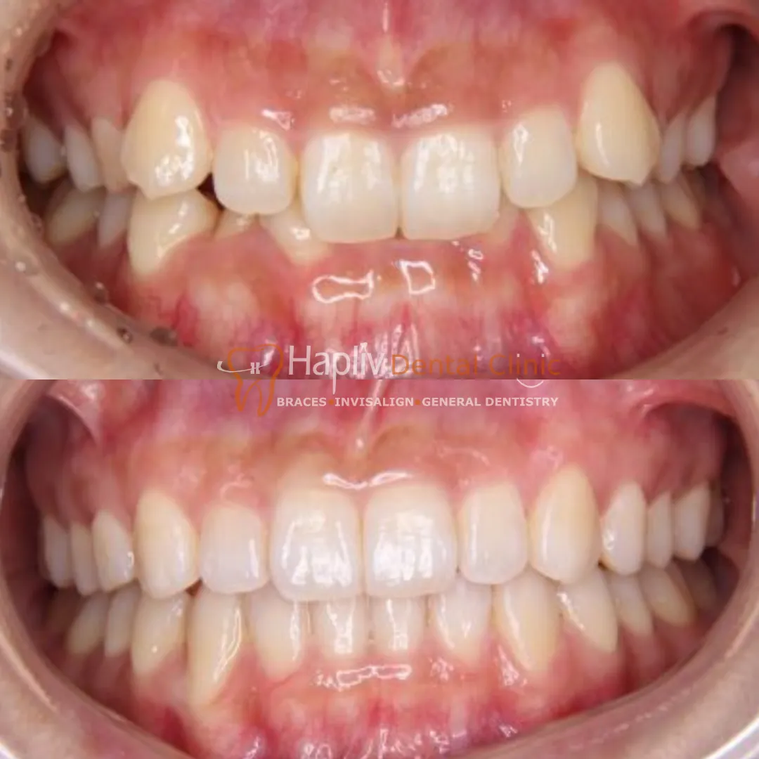 Invisalign Deep Bite case