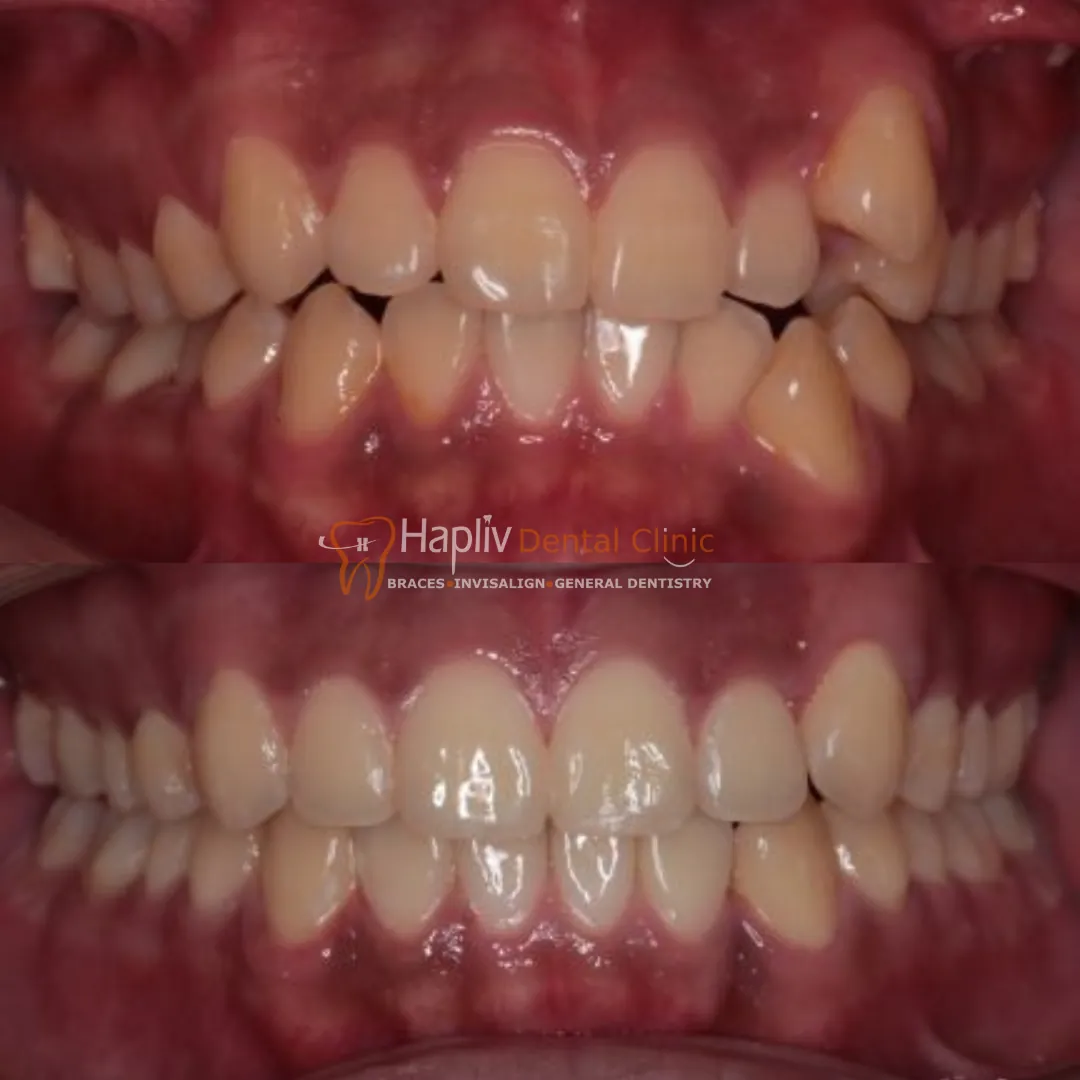 Invisalign Crowding before and after result