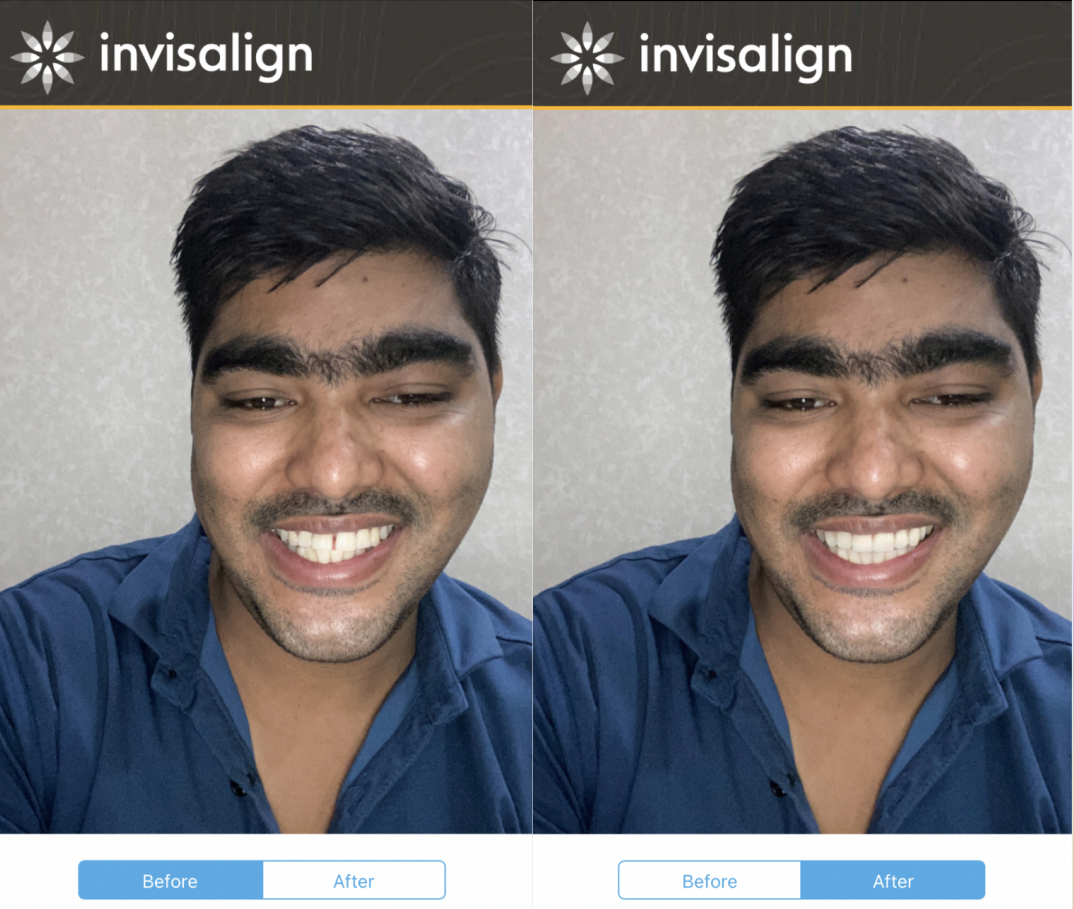 Digital scan visualising Invisalign tooth movements at Hapliv Dental Clinic